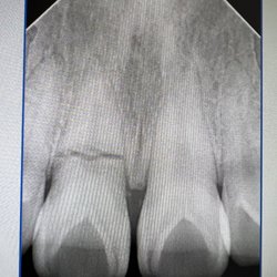 Valley Dental Group - Fractured front tooth due to an accident getting replaced by an immediate implant supported restoration