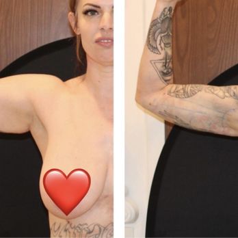 Tucson Cosmetics - Amazing results and this "after" was taken a day after surgery, so they were still swollen! - Cosmetic Surgeons Near Me - Tucson, Arizona