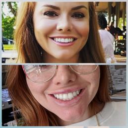 Before/after lip implants