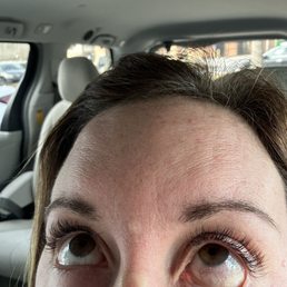 Eyeball redness