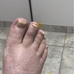 Wellness Pedicures By Jay - Medical Pedicure Diabetic Patient BEFORE