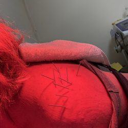 Wave Q Acupuncture Clinic - Me under the heat lamp