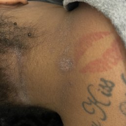 Ring worm from warm neck compress! The fu$&ing worst!