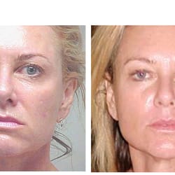 Microcurrent Face Sculpting