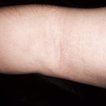 Concentra Urgent Care - The scar is barely visible from surgery now. No staples or suture lines. - Occupational Therapy Near Me - Placentia, California Concentra Urgent Care - The scar is barely visible from surgery now. No staples or suture lines. - Occupational Therapy Near Me - Placentia, California