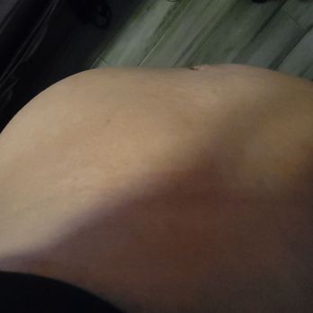 Doctors Plastic Surgery - Deformed stomach - Plastic Surgeons Near Me - New York, New York