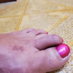 Chi Thomas, MD - Terrible hammertoe correction!
