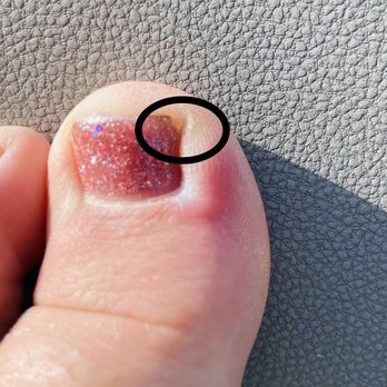 Biagio II Nail & Spa - This is where the corner of my nail was cut and pulled out(This was repeated on both corners on 4 toes) now I have an infection. - Nail Salons Near Me - Phoenix, Arizona