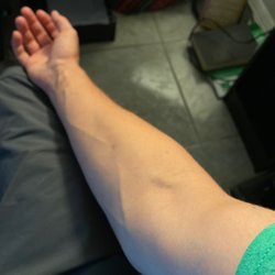 CSL Plasma - Normal arm