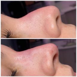 Non-surgical liquid rhinoplasty using filler Non-surgical liquid rhinoplasty using filler