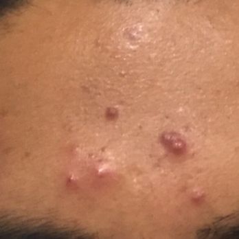 Gene Rubinstein, MD, FAAD - Before - Dermatologists Near Me - Studio City, California