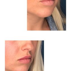 Cosmetic Med Solutions - Restalyne Silk