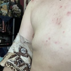 Appleton Plastic Surgery Center, SC - 3 month post op side view