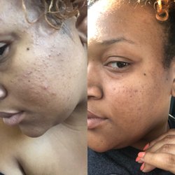 Face It Skincare - Left is Before facial versus the right which was a day afterwards