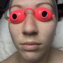 Sacred Hands Day Spa - Before dermaplane and hydrating facial.
