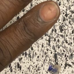The nail that was burning under left a bruise under my nail