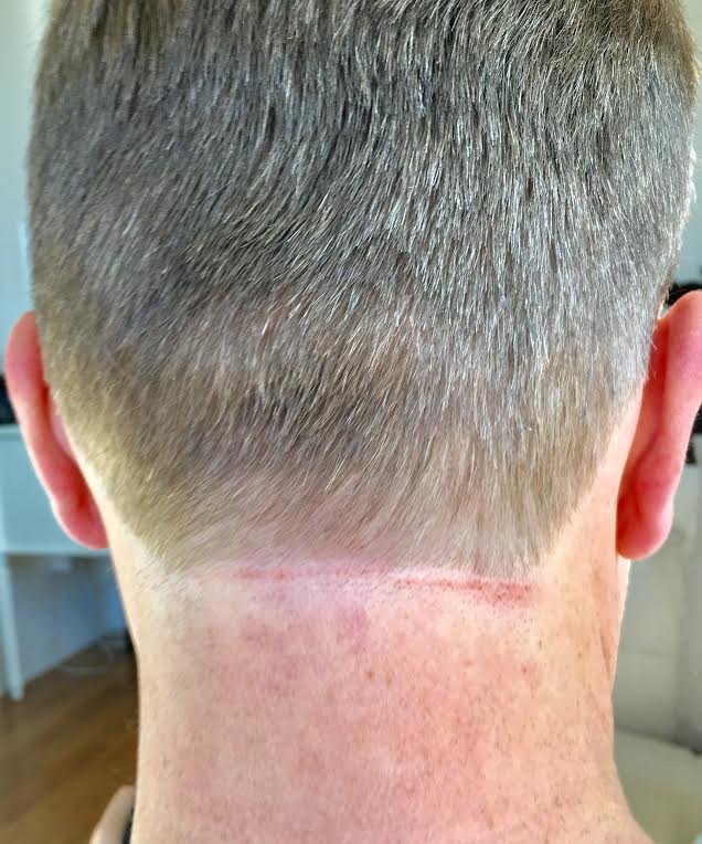 clippers cutting skin