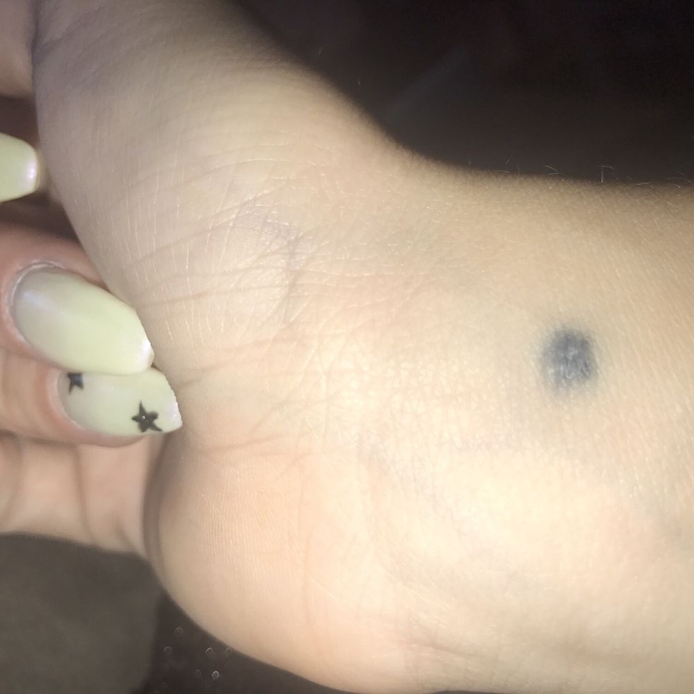 Update on how it has healed Update on how it has healed