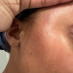 Hand & Stone Massage and Facial Spa - Bruised side of face. After facial