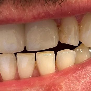Smiling Bright - Before - Teeth Whitening Near Me - Chicago, Illinois