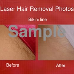 Burnt Hills Laser