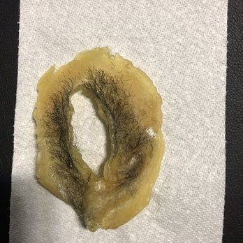 Hard Wax All Ingrown Hairs Removed Yelp
