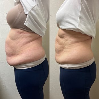 Contour By Laur - Intro client special. 3 different services in one session! - Body Contouring Near Me - Laguna Niguel, California Contour By Laur - Intro client special. 3 different services in one session! - Body Contouring Near Me - Laguna Niguel, California
