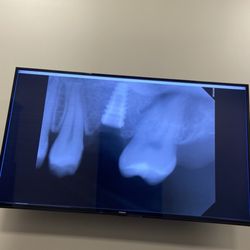 Murfreesboro Oral Surgery & Implant Cente - Implant