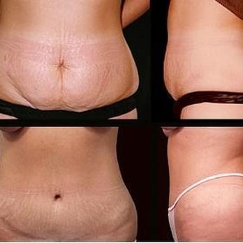 Texas Vein & Aesthetics - Smartlipo MPX is ideal for the areas of skin laxity, such as the neck and arms or for the removal of fat from the abdomen, lo... - Medical Spas Near Me - Denton, Texas Texas Vein & Aesthetics - Smartlipo MPX is ideal for the areas of skin laxity, such as the neck and arms or for the removal of fat from the abdomen, lo... - Medical Spas Near Me - Denton, Texas