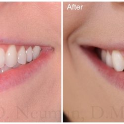 Bluegrass Periodontics - Before and After Cosmetic Crown Lengthening for Correction of a Gummy Smile
