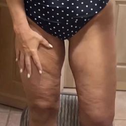 Dr. Ricardo Vega - BEFORE - thighs