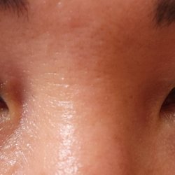 Adam J Cohen, MD - Horrific eyelids and damaged vision after 3rd surgery.