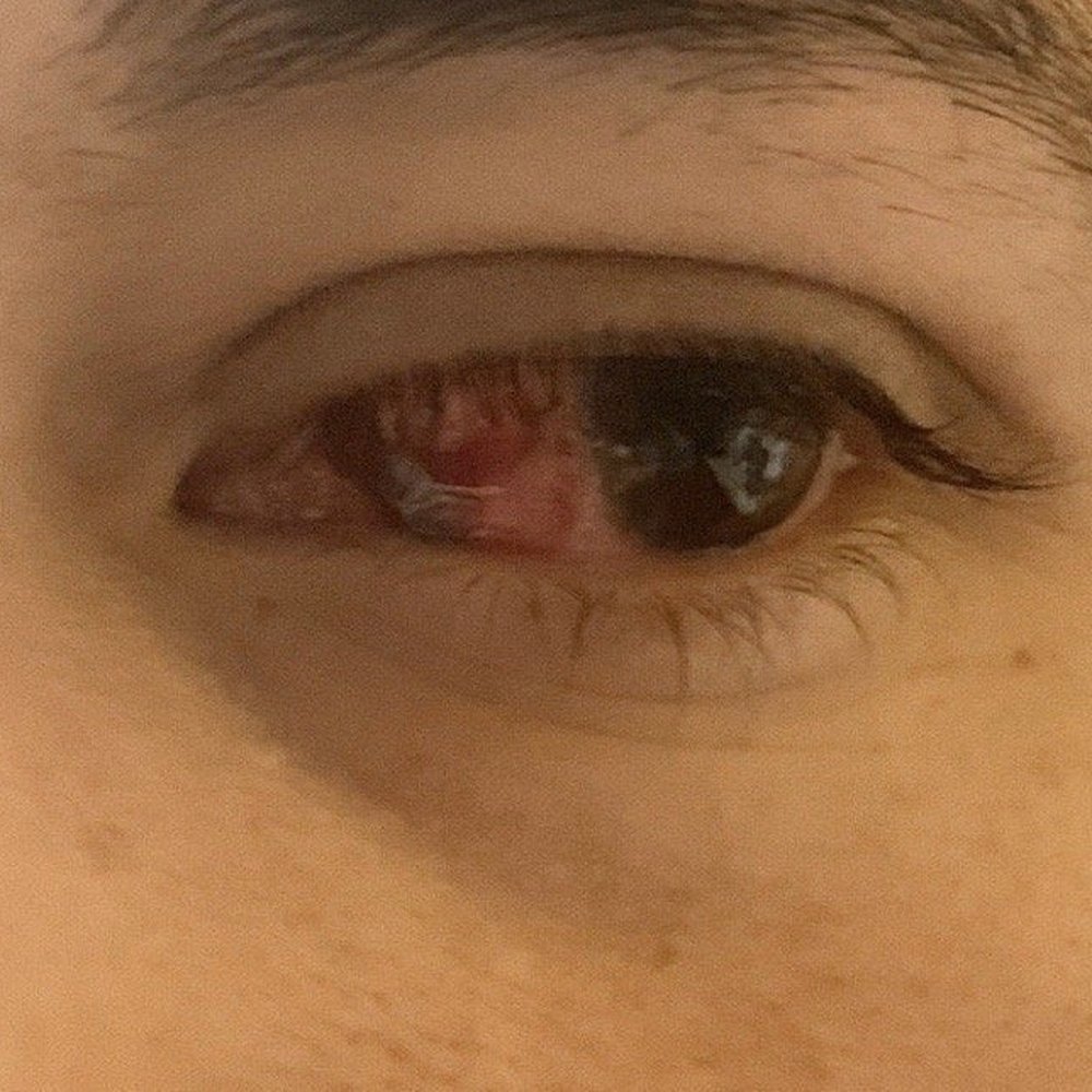 Laser Eye Center - Encino - pterygium surgery on Friday 21st. - Laser Eye Surgery/Lasik Near Me - Encino, California Laser Eye Center - Encino - pterygium surgery on Friday 21st. - Laser Eye Surgery/Lasik Near Me - Encino, California