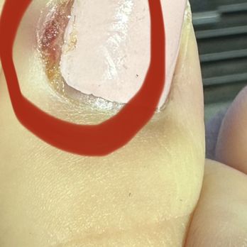 Marshalls Nails & Spa - Infected toe THE DAY after pedicure - Nail Salons Near Me - Hoffman Estates, Illinois