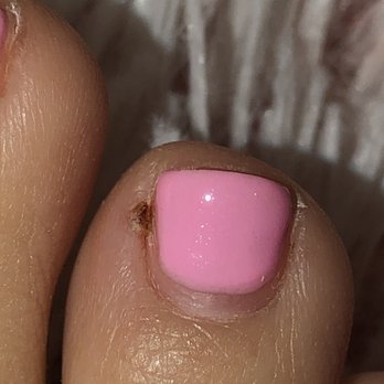 Allure Nails and Spa - This is after 6days of healing !!! Deep hole in my finger toe! It hurt so bad for about 4 days ! - Nail Salons Near Me - Rialto, California Allure Nails and Spa - This is after 6days of healing !!! Deep hole in my finger toe! It hurt so bad for about 4 days ! - Nail Salons Near Me - Rialto, California