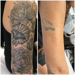 MEDermis Tattoo Removal - Before and after 10 laser treatments