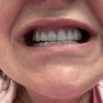 Santa Fe Dental Group - The entire top row was made by one doctor with one hand. 12 crowns, all different colors, sizes, shapes. - General Dentistry Near Me - Santa Rosa, California Santa Fe Dental Group - The entire top row was made by one doctor with one hand. 12 crowns, all different colors, sizes, shapes. - General Dentistry Near Me - Santa Rosa, California