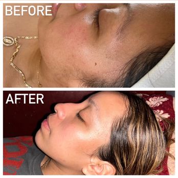 Rejuv Me Care - Before & After - Skin Care Near Me Rejuv Me Care - Before & After - Skin Care Near Me