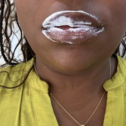 Not Just Lips - Numbing cream did numb my lips but I still felt the needle