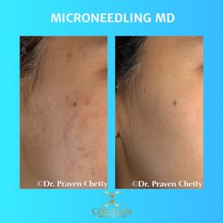 Cerulean Medical Institute - Medical Microneedling for acne scars at Cerulean Medical Institute in Kelowna BC for a smoother, more even skin tone and texture