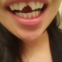 Sterling Pointe Family Dentistry - My painful broken and shattered teeth.