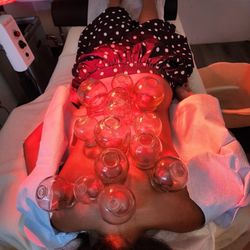 Northridge Acupuncture - Cupping therapy