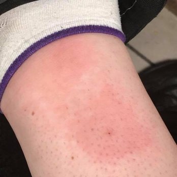 Marque Urgent Care - Infection due to a bee sting. - Urgent Care Near Me - La Mesa, California