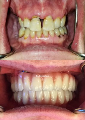 All on 4 - Denture Implants - All on 4 or All on Fours is a procedure where you get a more permanent solution compared to dentures. These implant retained dentures are permanent don't need glue and can last a lifetime. All on 4 - Denture Implants - All on 4 or All on Fours is a procedure where you get a more permanent solution compared to dentures. These implant retained dentures are permanent don't need glue and can last a lifetime.