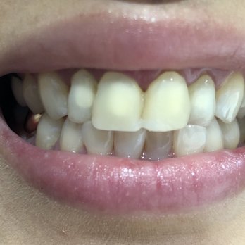 Symphony Dental - Temporaries before the real deal - Orthodontists Near Me - Los Angeles, California Symphony Dental - Temporaries before the real deal - Orthodontists Near Me - Los Angeles, California