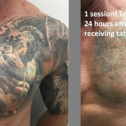 Michael Sarti, MD - Yes, it's safe to treat in the first 24 hours - in fact more ink comes out.