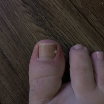 Q Nail Lounge - Puss and infection from nick during pedicure....two days later. - Nail Salons Near Me - Tucson, Arizona