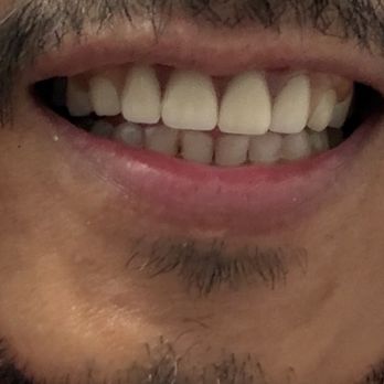 Cedar Smiles Dentistry - This is me before the procedure. Way better shape and design. - General Dentistry Near Me - Bellflower, California