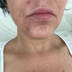 Amenities Aveda Spa & Salon - This is after a week of treatment to remove the pimples, unfortunate treatment.