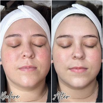 Faces by Celeste - Dermaplaning results - Skin Care Near Me - Valencia, California Faces by Celeste - Dermaplaning results - Skin Care Near Me - Valencia, California